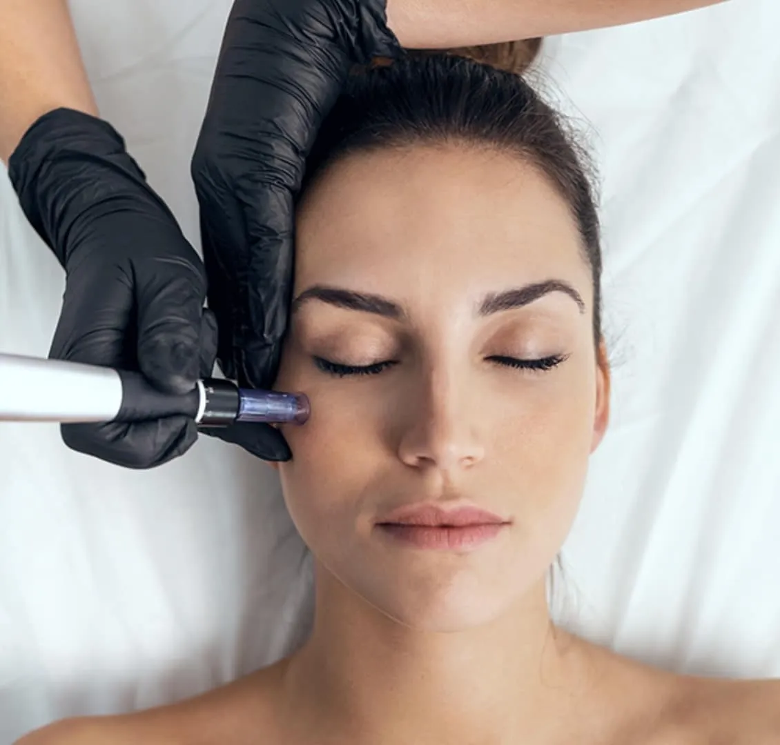Microneedling Nanoneedling