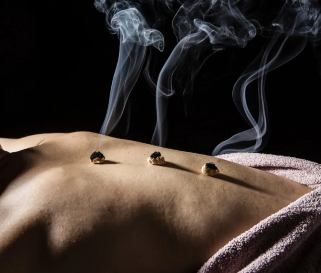 Moxibustion