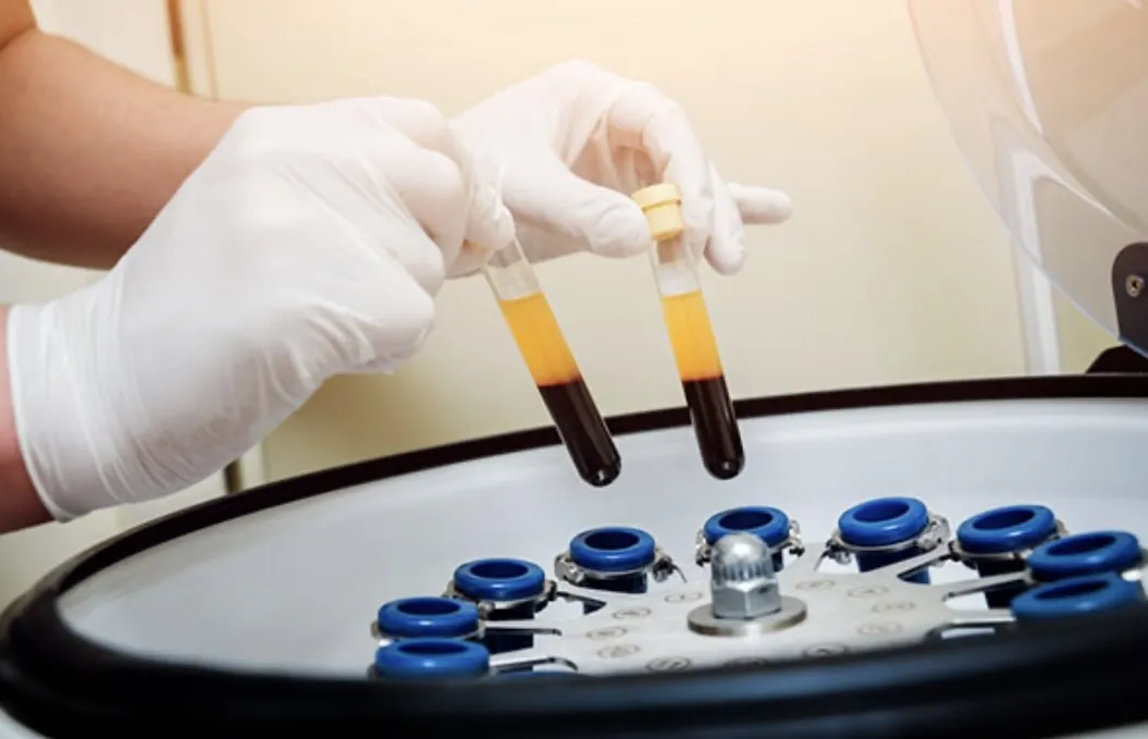 Platelet rich plasma PRP