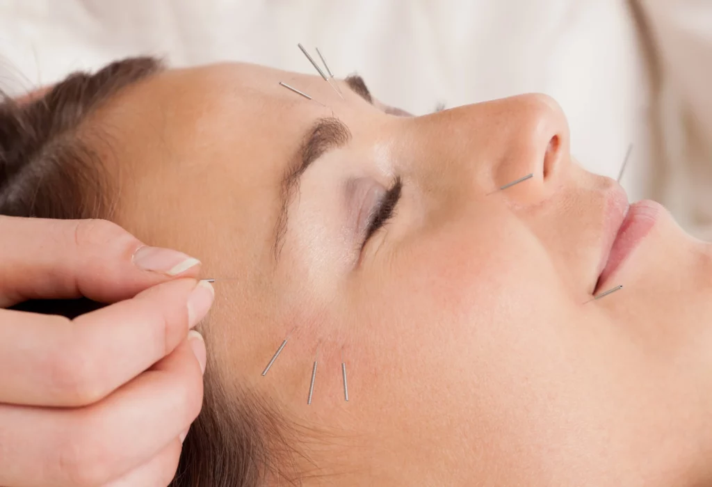 cosmetic acupuncture facial newport beach