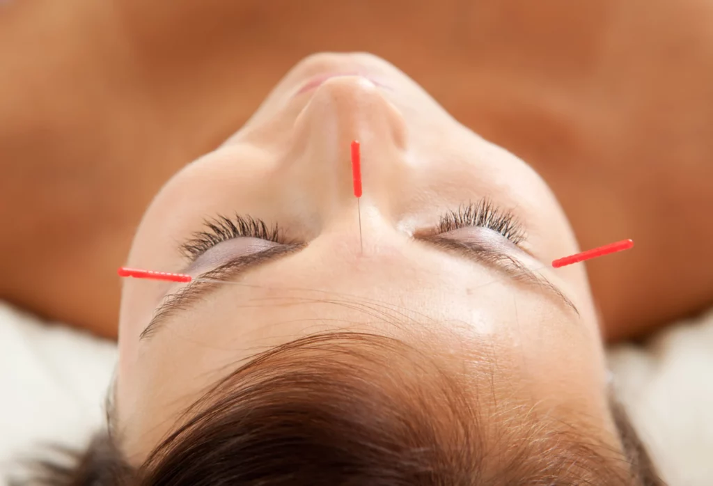 cosmetic acupuncture newport beach