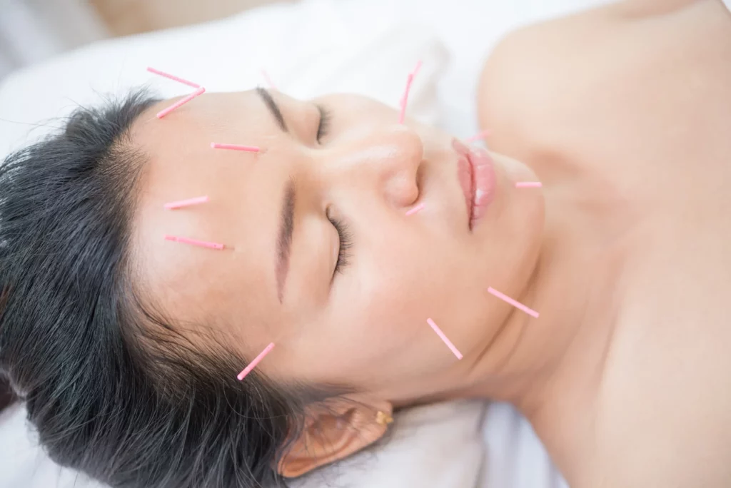 cosmetic acupuncture rejuvenation facial newport beach