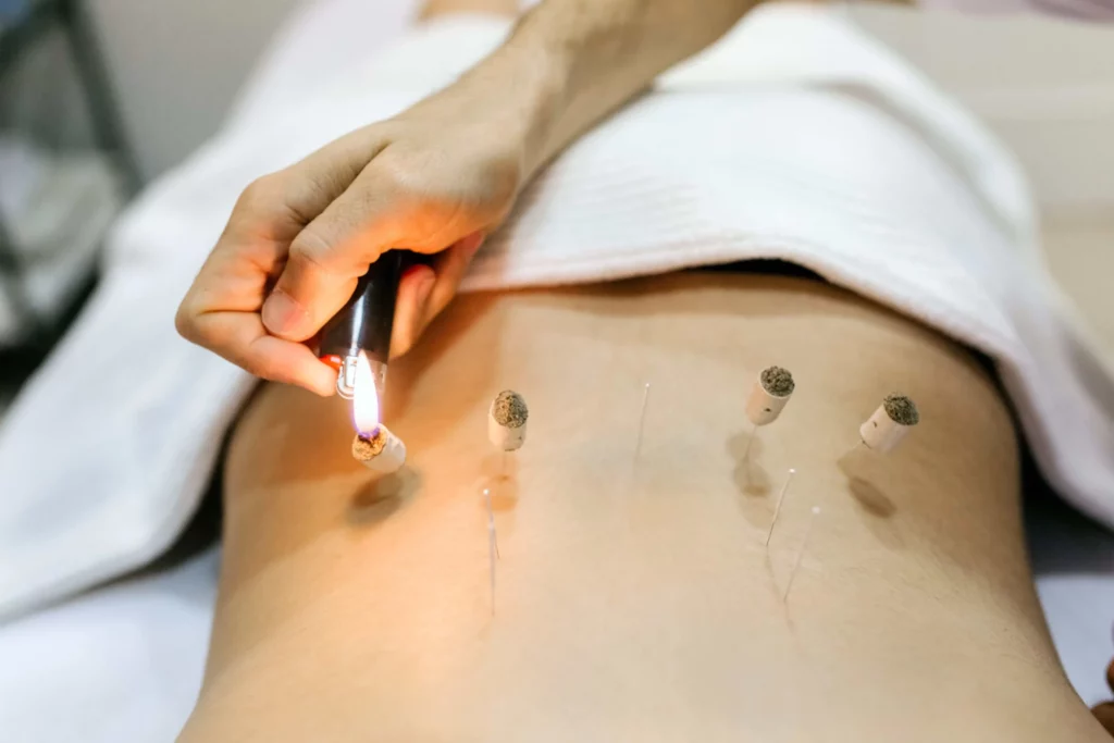 Does Moxibustion Newport Beach Orange county