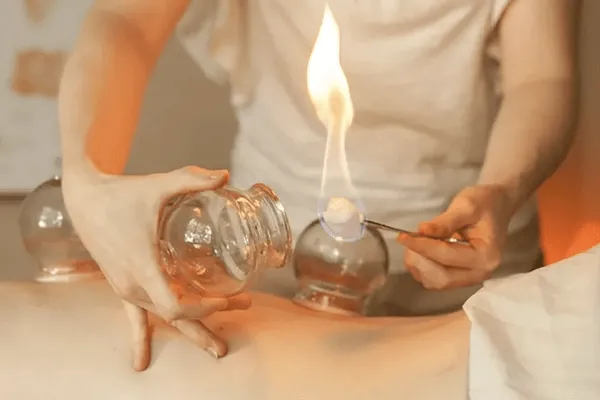 Fire cupping