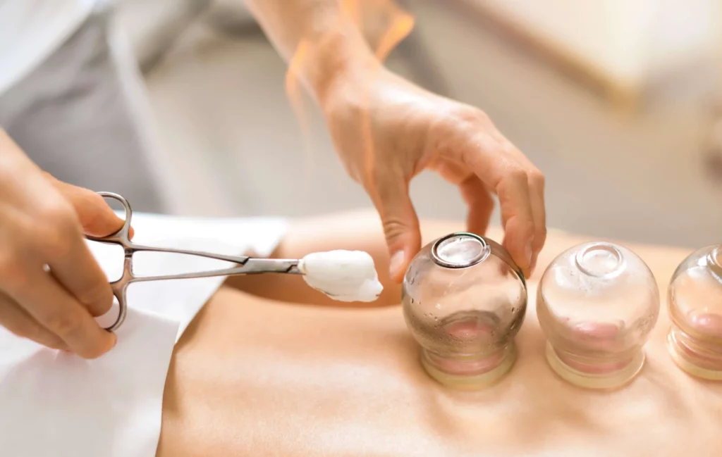 cupping Newport Beach Orange county