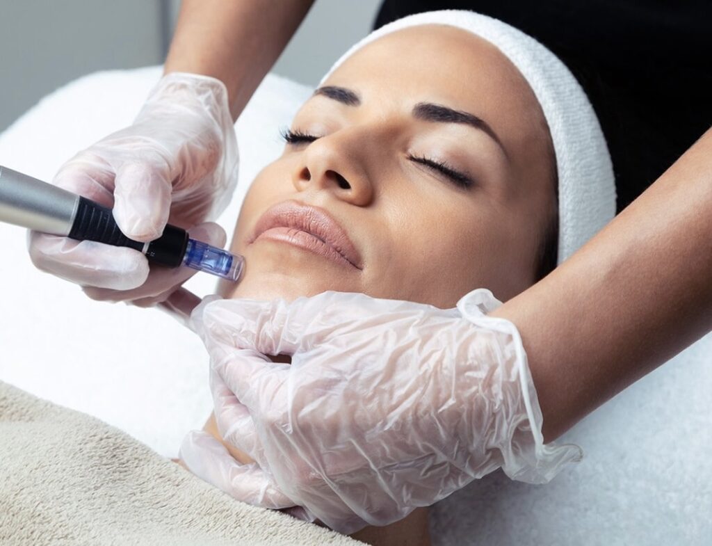Microneedling cost newport beach