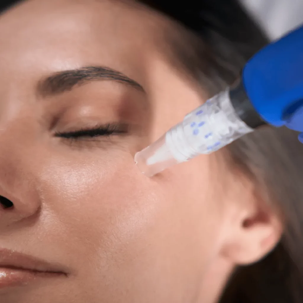 Newport beach microneedling