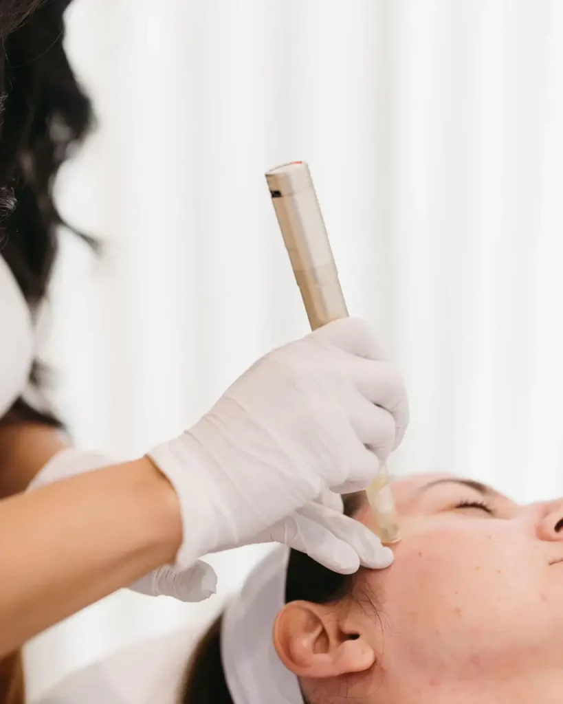 microneedling in Newport beach