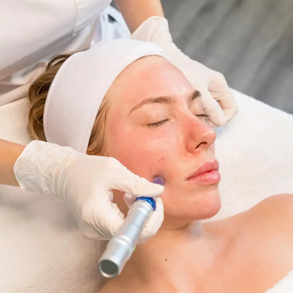 microneedling newport beach