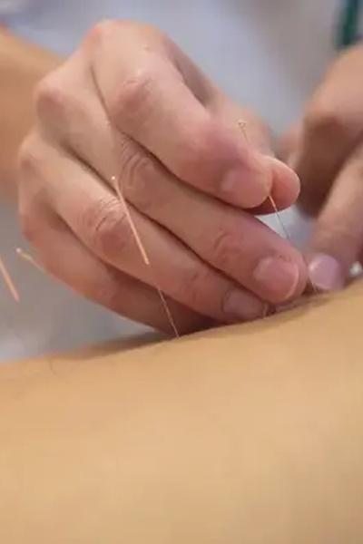 acupuncture-newport-beach-ca